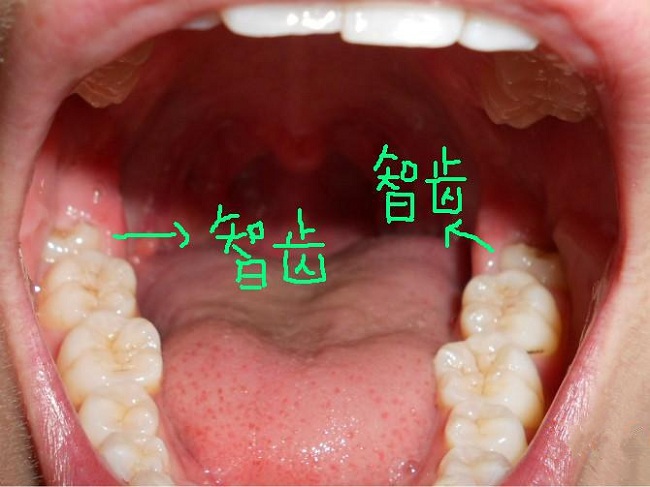 广东省口腔拔智齿统筹，政策解读与民众福音