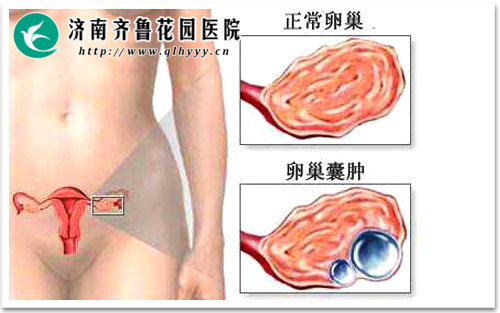 卵巢囊肿的康复之旅，三个月中药的坚持与希望